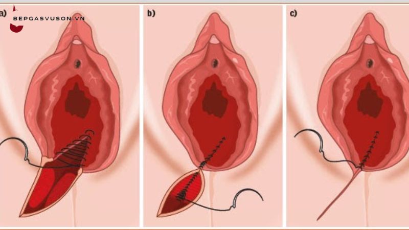 Phẫu thuật thẩm mỹ vùng kín có thể giúp nhiều người cảm thấy tự tin hơn